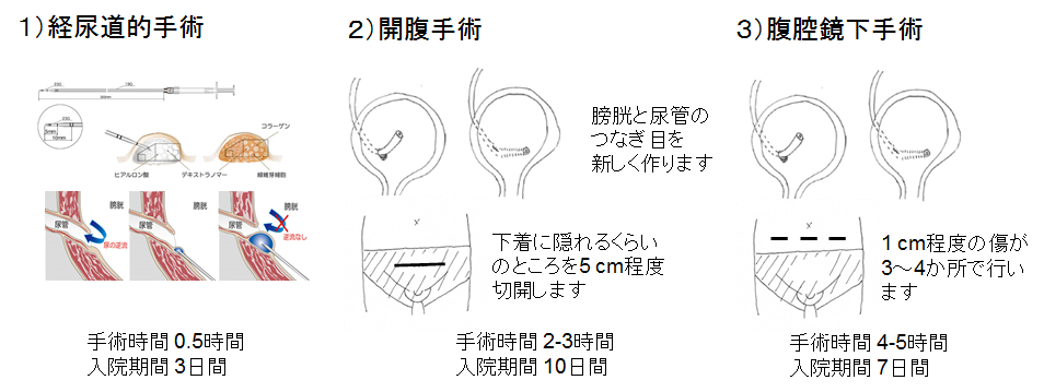 膀胱尿管逆流症について