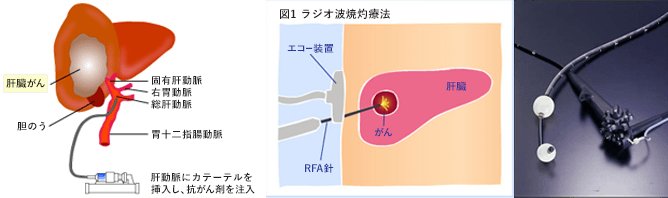 画像：（1）肝臓がんに冠動脈にカテーテルを挿入し、抗がん剤注入する方法（2）ラジオ波焼灼療法：肝臓部分の肌にエコー装置を当てて、REA針で肝臓ガンにラジオ波電流を流す（3）治療に使う装置