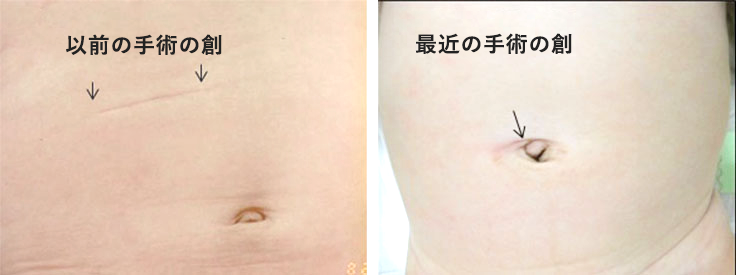 写真左：以前の赤ちゃんの術後の創の様子、写真右：最近の赤ちゃんの術後の創の様子