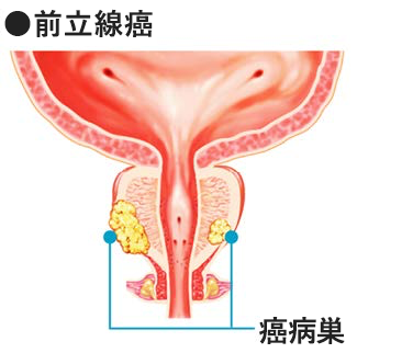 図：前立腺癌の図解