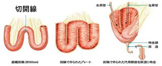図：代用膀胱造設術の図解