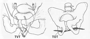図：女性の腹圧性尿失禁に対するスリング手術（TVT・TOT）の図解