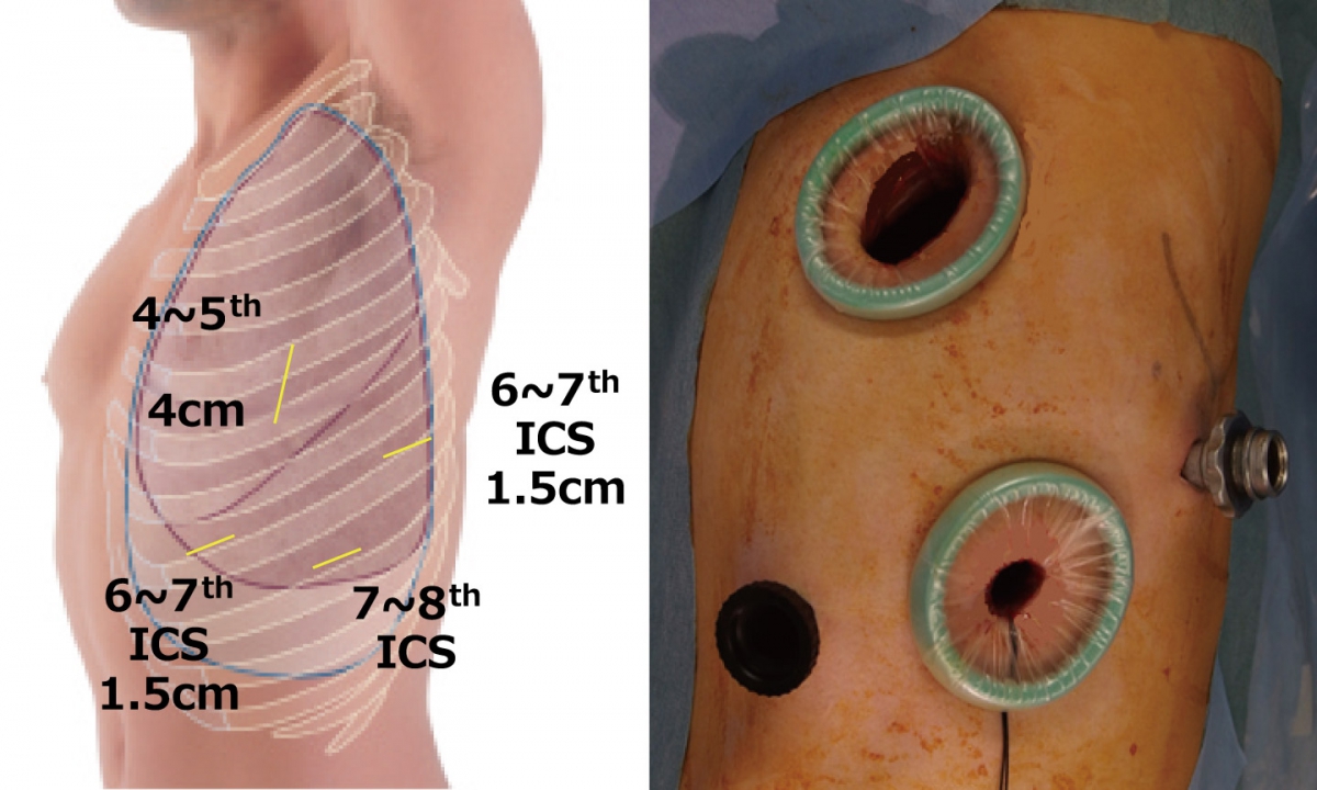 胸腔 穿刺 について 正しい の は どれ か