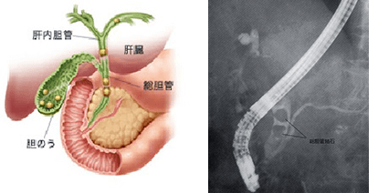 左画像：体内図：胆のう、肝内胆管、肝臓、総胆管、右画像：総胆管結石のレントゲン写真