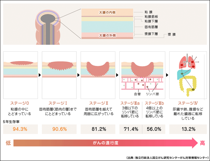 ん 大腸 が