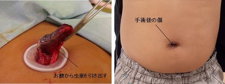 写真左：臍から虫垂を引き出す様子、写真右：術後の傷の様子