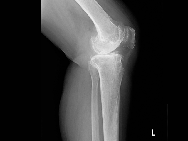 写真：人工膝関節全置換術前のレントゲン写真2