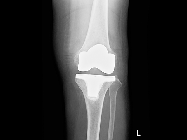 写真：人工膝関節全置換術後のレントゲン写真1