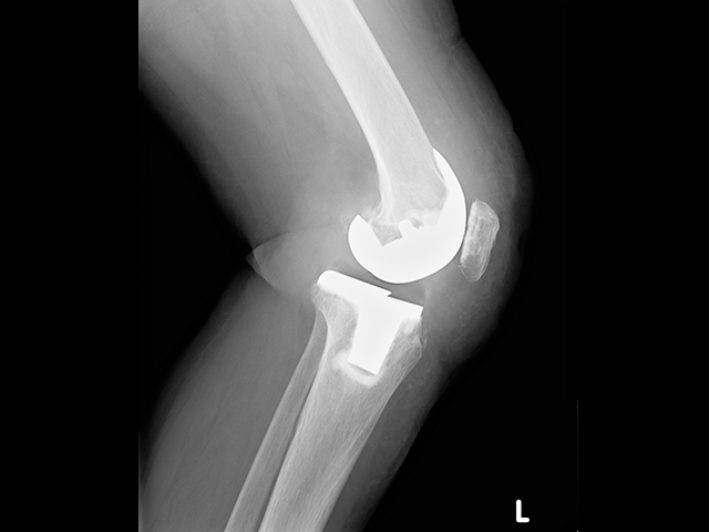 写真：人工膝関節全置換術後のレントゲン写真2