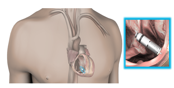 図：Micra TPSが心臓の右心室内に固定される様子